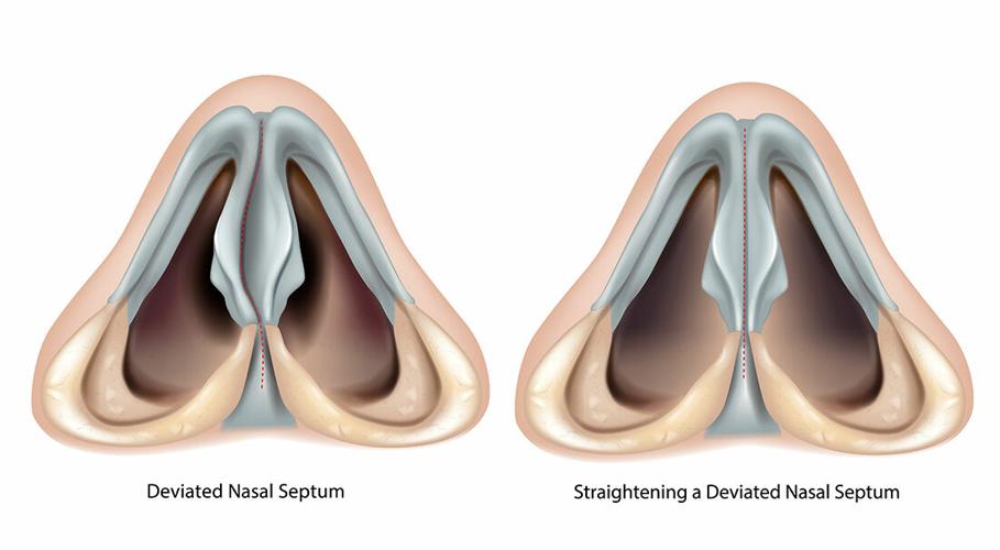 Deviated nasal septum and Straightening a Deviated Nasal Septum. Septoplasty and Rhinoplasty